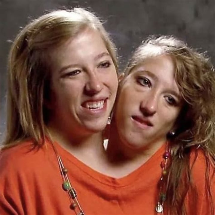 Abby and Brittany Death: The Tragic Tale of the World's Most Famous Conjoined Twins