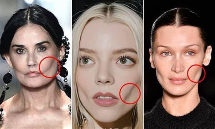 Celebrities Who Got Buccal Fat Removal: Unveiling the Secrets Behind Their Slim Faces