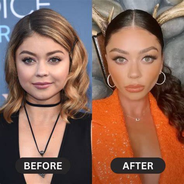Celebrity Buccal Fat Removal Before and After: Unveiling the Transformation