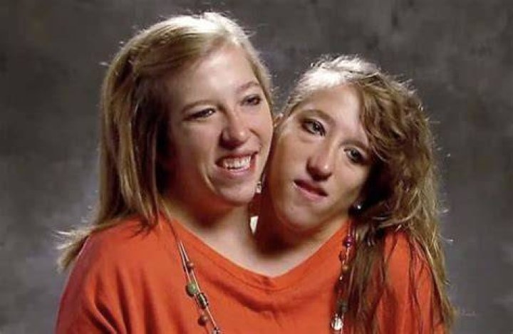 Conjoined Twins Abby and Brittany: The Sad News That Touched Hearts Worldwide