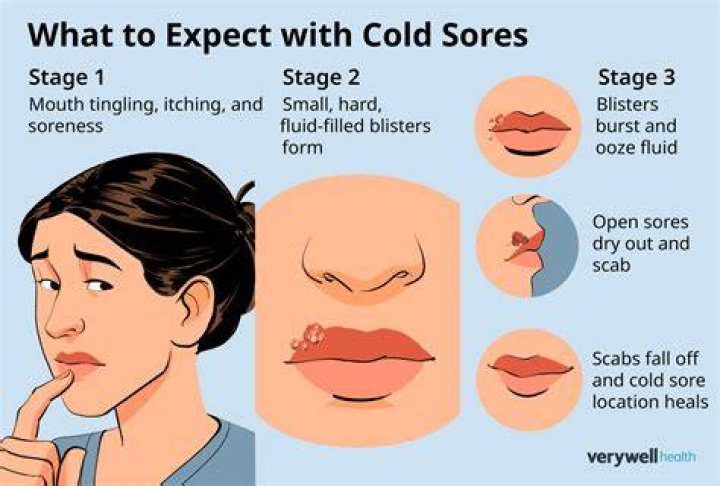 Do You Pop a Cold Sore? The Complete Guide to Understanding and Treating Cold Sores