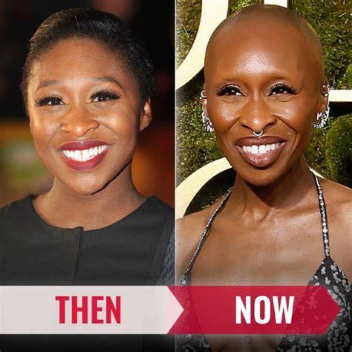Does Cynthia Erivo Have Alopecia? Exploring the Facts and Understanding Alopecia