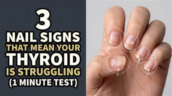 Nail Ridges and Thyroid Problems: What You Need to Know