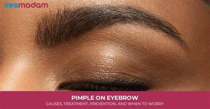 Pimple in Eyebrows: Causes, Treatments, and Prevention Tips