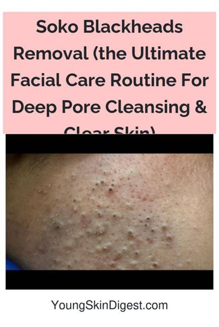 Skin Care Regimen for Blackheads: Your Ultimate Guide to Clear and Radiant Skin