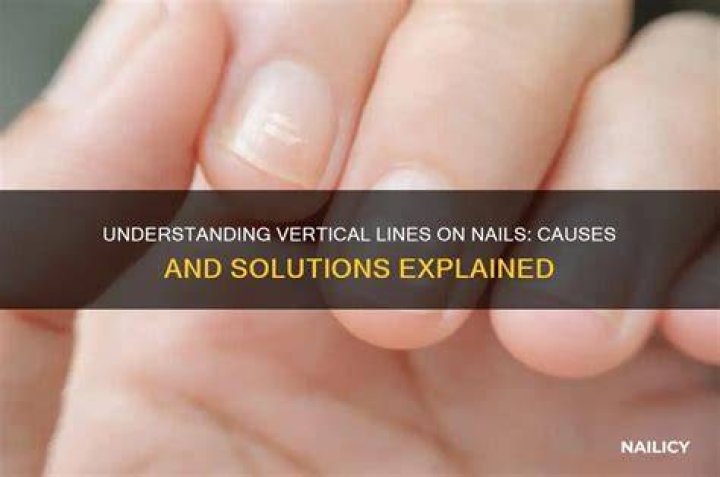 Vertical Lines in Nails Thyroid: Understanding the Connection
