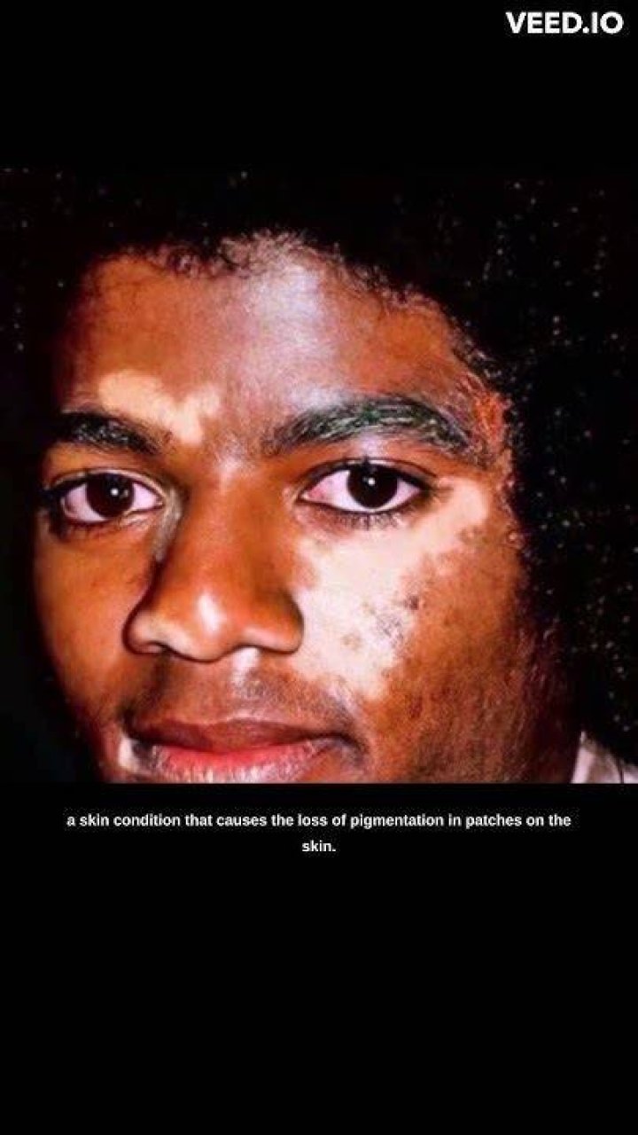 Vitiligo Michael Jackson: Understanding the Skin Condition That Shaped a Legend