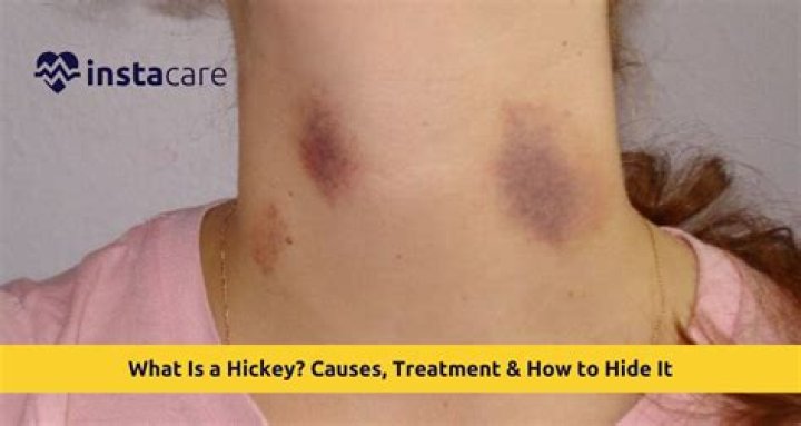What is a Hickey on Neck? Understanding Its Causes, Effects, and Remedies