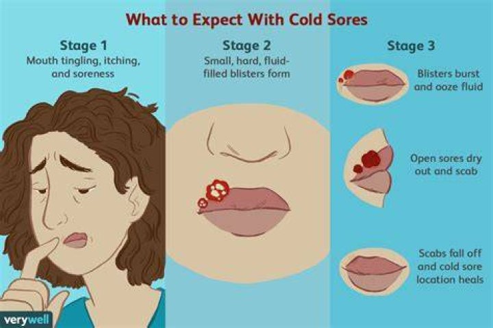 Will a Cold Sore Pop? Understanding the Myths and Realities